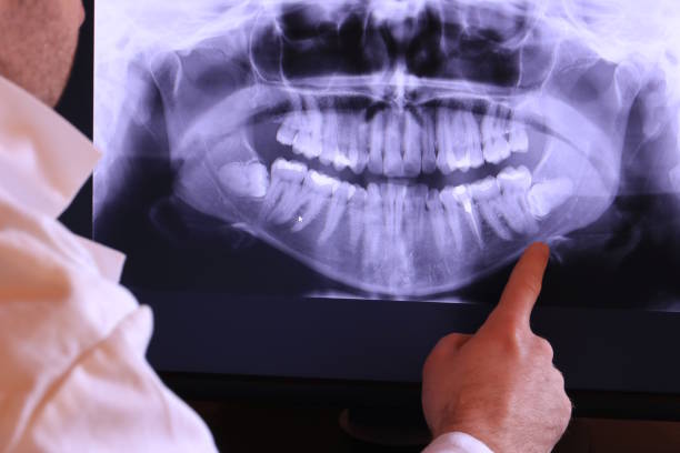 Best Emergency Dental Extractions in Indian Shores, FL